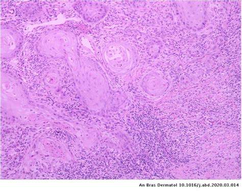 Squamous Cell Carcinoma Superimposed On Necrobiosis Lipoidica A Rare