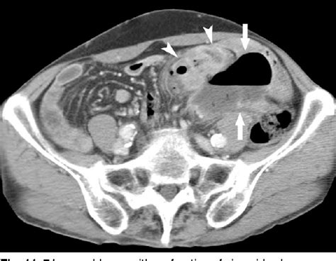Figure 8 From Gastrointestinal Tract Perforation Mdct Findings
