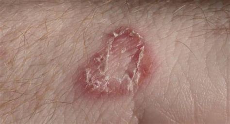 Fungal Infections Of The Skin Pictures Images The Meta Pictures