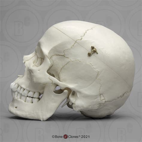 Human Male European Skull With Calvarium Cut Bone Clones Inc