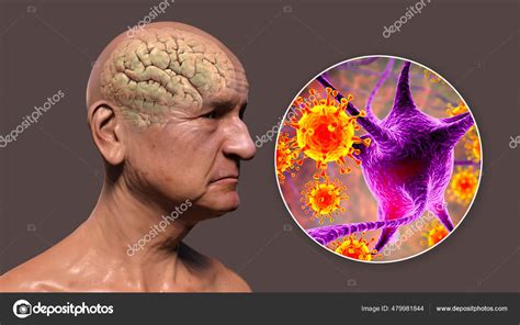 Infectious Etiology Dementia Conceptual Illustration Showing Elderly