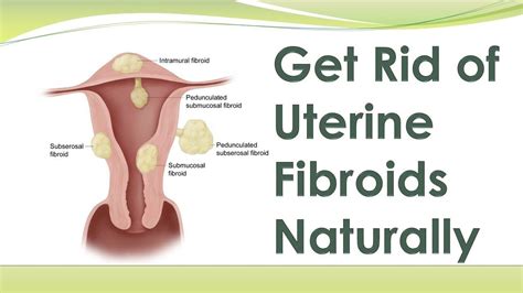 Pin On Get Rid Of Uterine Fibroids
