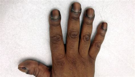 Derm Dx Clubbed Fingers In A Patient With Graves Disease Clinical
