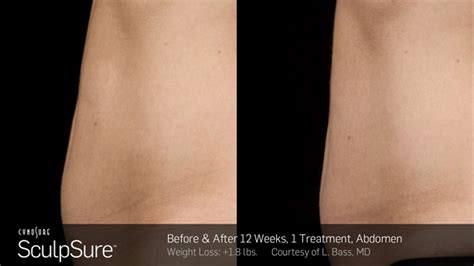 Sculpsure Before And After Gallery Dermatologist In Honolulu Hi