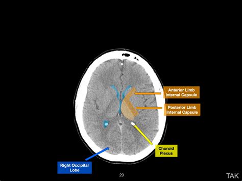 Teaching Head Ct With Annotated Scrollable Images Image