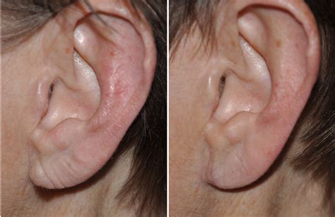 Earlobe Enhancement With Injectable Fillers Explore Plastic Surgery