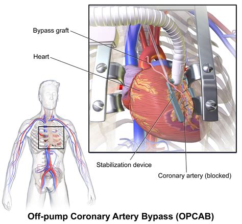 Heart Surgery Types Open Bypass Ablation Heart Valve Surgery