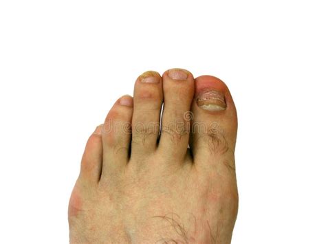 Bruises Bunions Broken Toes Stock Image Image Of Aging Abnormality