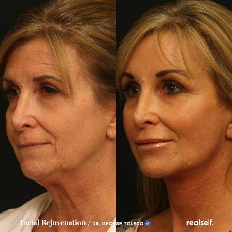 How Much Does A Facelift Cost And Is It Worth It Realself Skin