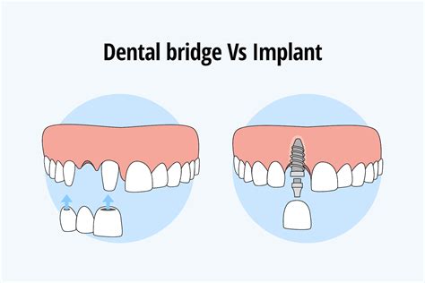 Dental Bridges Vs Implants Cost Benefits Crofton Dental Care