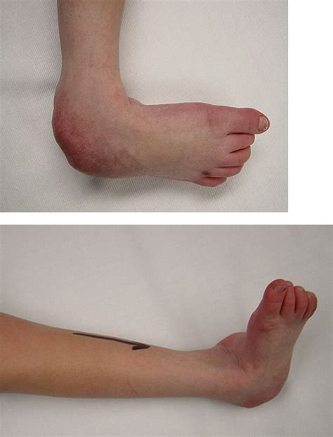 Ilizarov External Fixation In The Correction Of Severe Pediatric Foot