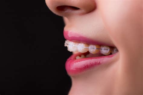 How Your Fort Worth Orthodontist Limits The Visibility Of Braces | Fort ...