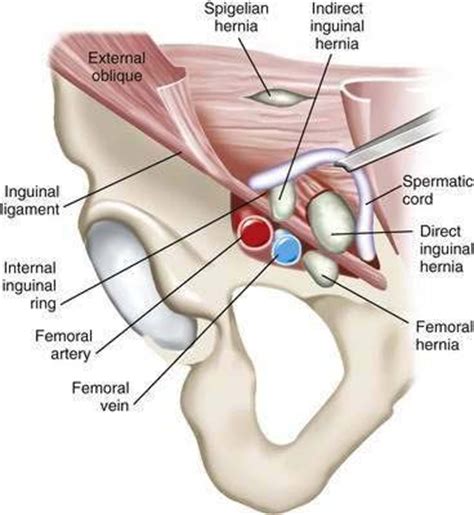 In girls or women, inguinal hernias may contain part of the female reproductive system, such as an ovary. Abdominal Hernias and Gastric Volvulus | Abdominal Key