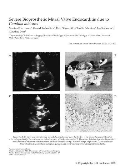Severe Bioprosthetic Mitral Valve Endocarditis Due To Icr Heart