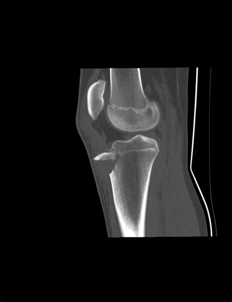 Tibial Tubercle Avulsion Fracture Radiology Case