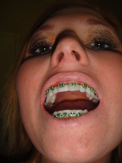 Some braces are made specifically for boys while others are specifically designed for girls. Getting Braces