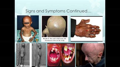 Progeria Definition Types Symptoms Facts Britannica