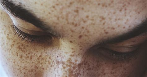 What Causes Brown Freckles Visit Link