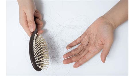 What Is Seborrheic Dermatitis Does It Cause Hair Loss