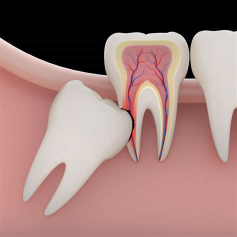 Your dentist or oral surgeon may use one of three types of anesthesia, depending on the expected complexity of the wisdom tooth extraction and your comfort level. Wisdom Teeth Removal | 4 Locations in Georgia | Dental Town