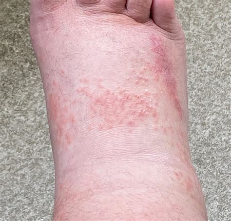 Extremely Swollen Feet 8 Days With A Bumpy Rash On Top 4 Days 36