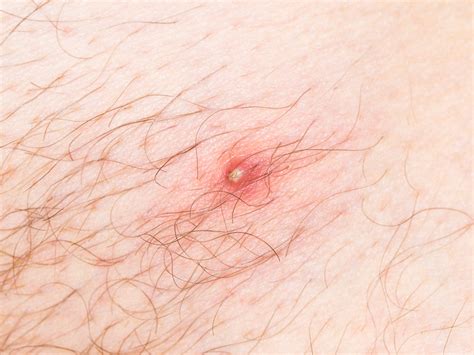 How To Get Rid Of Ingrown Hairs Business Insider