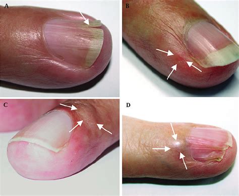 Fingernail And Nailbed Abnormalities In Four Patients With Nf1 And