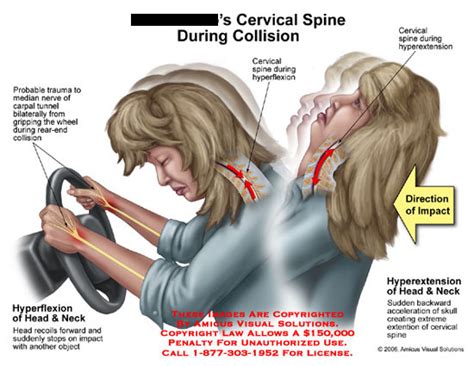 Amicus Illustration Of Amicusinjurycervicalspinerearimpact
