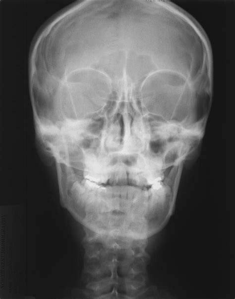 Skull Lateral View Buyxraysonline