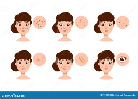 Woman With Skin Problem Acne Vector Stock Vector Illustration Of