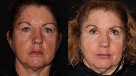 Halo Skin Rejuvenation Before And After Pictures Case 2 Chico Yuba