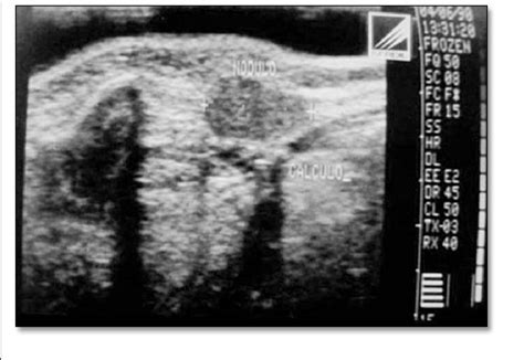 Normal Submandibular Gland Ultrasound