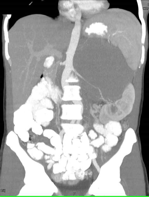 Gastric Exophytic Gist Tumor Stomach Case Studies Ctisus Ct Scanning