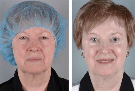 Droopy Eyelid Surgery Before And After Pictures Designetnic