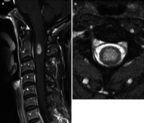 Spinal Cord Tumors Anatomic And Advanced Imaging Radiology Key