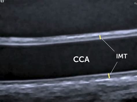 2 Carotid Ultrasound Anatomy 123 Sonography