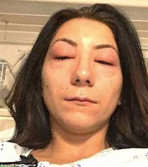 Ottawa Womans Eyes Swollen Shut From Eyelash Extensions Daily Mail