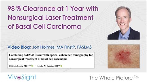 Oct Guided Laser Treatment Of Basal Cell Carcinoma Youtube