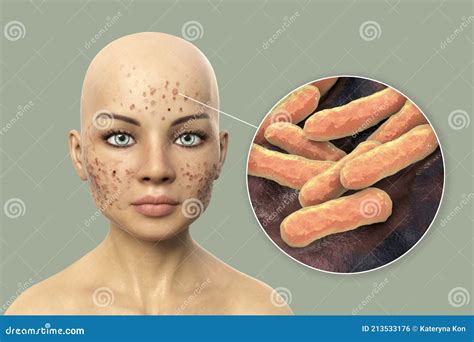 Acne Vulgaris On Skin And Closeup View Of Bacteria Stock Illustration