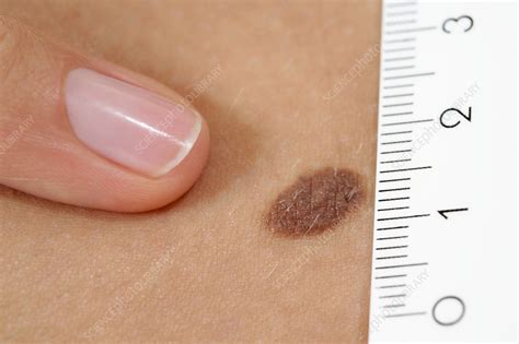 Nevus Stock Image C0020828 Science Photo Library