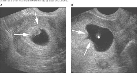 Figure 3 From The Chorionic Bump A First Trimester Pregnancy