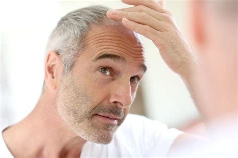 Alopecia Androg Nica Qu Es Causas Y Tratamiento