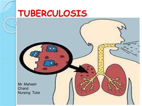 Tuberculosis Ppt