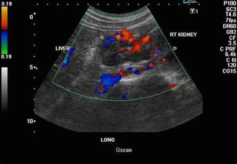 Upper Abdominal And Retroperitoneal Ultrasound K And T Diagnostic Inc