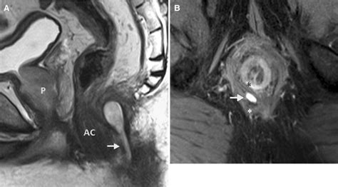 Mri Of Anal Canal Normal Anatomy Imaging Protocol And Perianal Fistulas Part 1 Springerlink