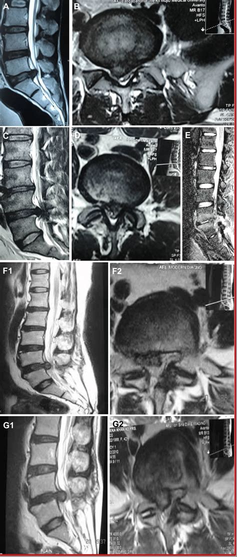 MRI Of Lumbar Disc Herniation L5 S1 Level A B At L4 5 Level C D