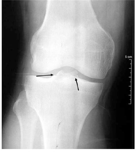 Plain film chest xray is the most common examination on radiology department. Eminentia tibialis fracture in the AP knee X-ray ...