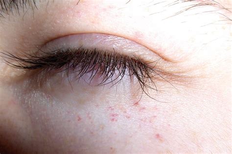 Rash Under Eye Pictures Pictures Photos