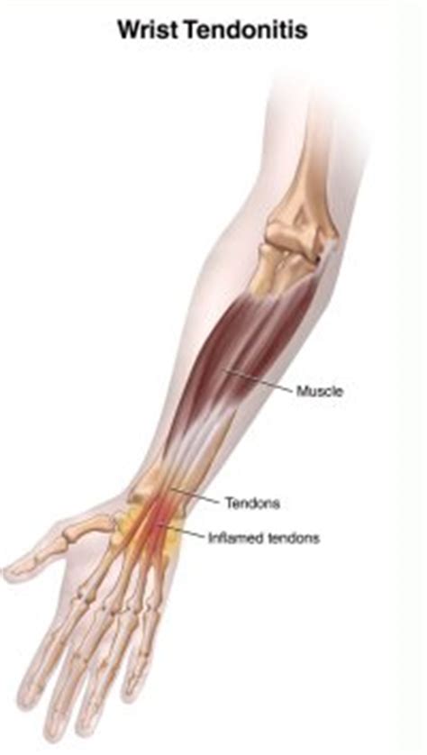 The word tendinosis refers to a swelling of the tendons. Tendinite: Infiammazione del Polso. - Infiammazione.com