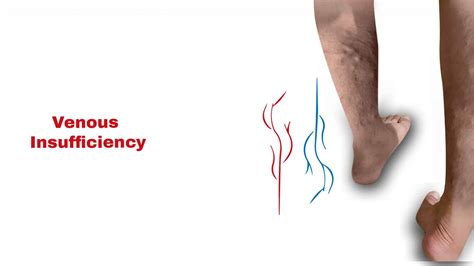 Venous Insufficiency Stat Cardiologist